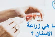 ما هي زراعة الاسنان