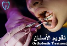 ماهو تقويم الاسنان
