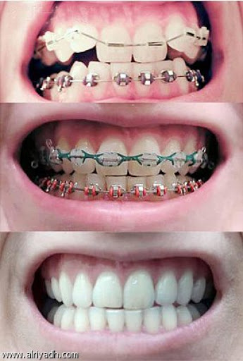 نتائج تقويم الأسنان
