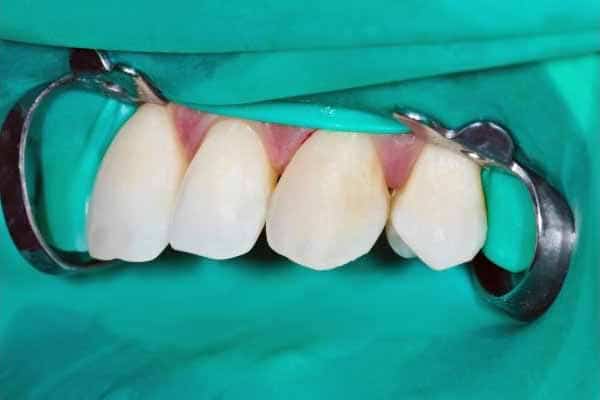 أدوات طب الأسنان واسمائها بالصور