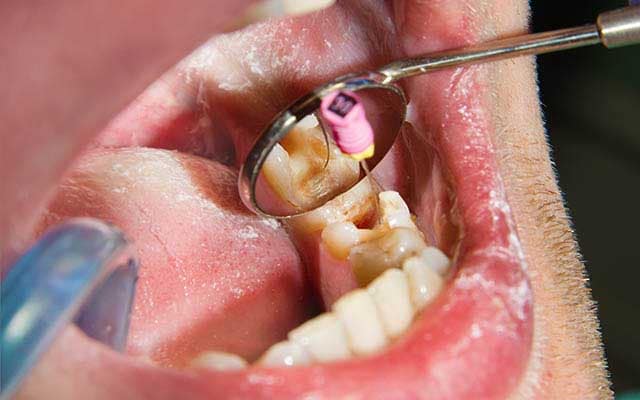 أنواع علاج جذور الأسنان