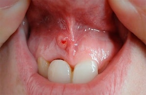 التهاب داخل الفم