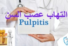التهاب عصب السن