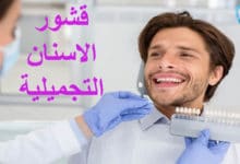 قشور الاسنان التجميلية