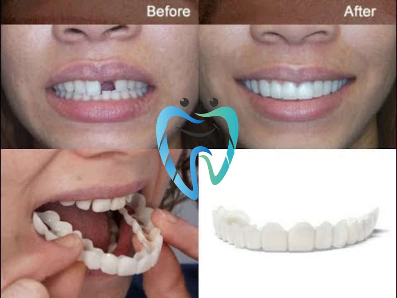 фото протезирования передних зубов