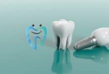 أنواع الزرعات السنية