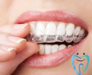 أنواع تبييض الأسنان
