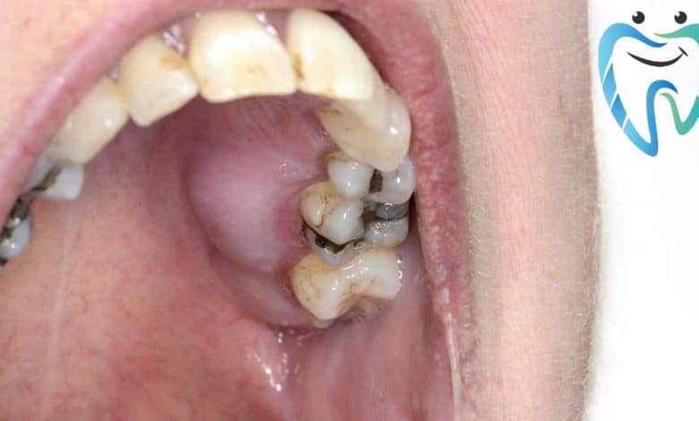 الخراج الأسنان علاج علاج خراج