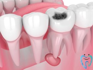 علاج سريع لألم الأسنان