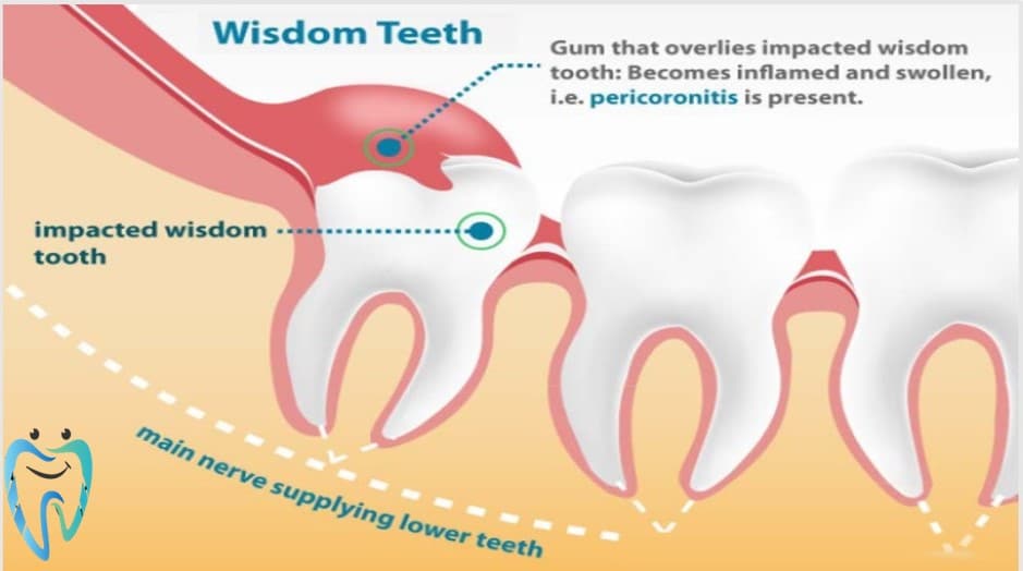 Wisdom tooth