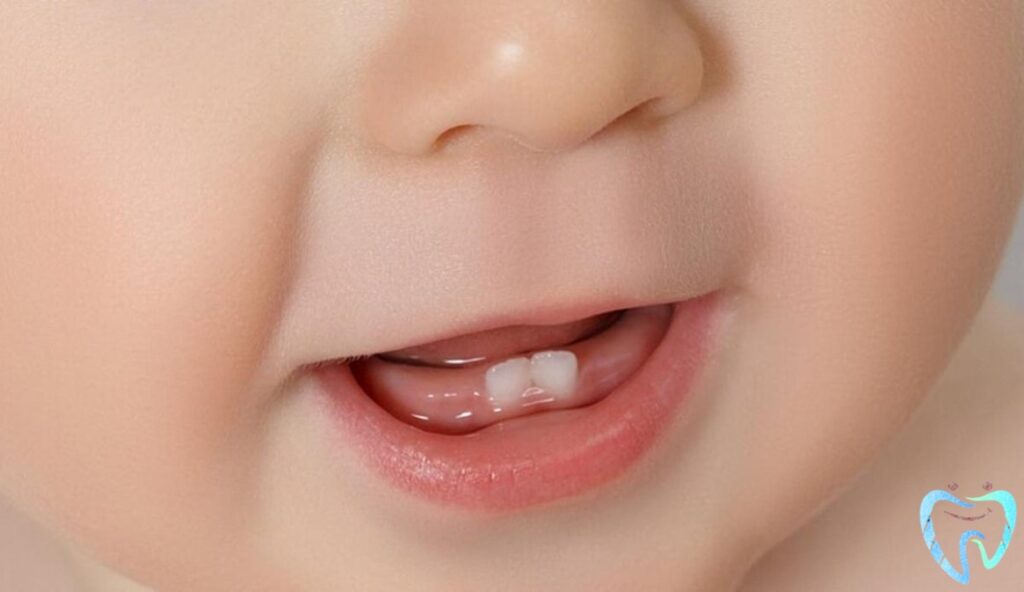 الأسنان الولادية