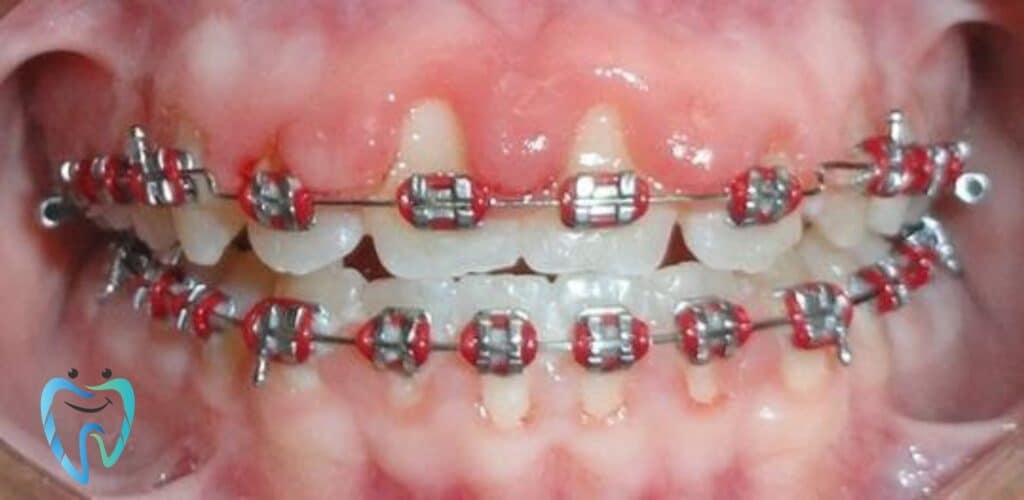 أجهزة تقويم الأسنان 