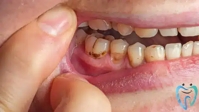 ما هو بلاك الأسنان
